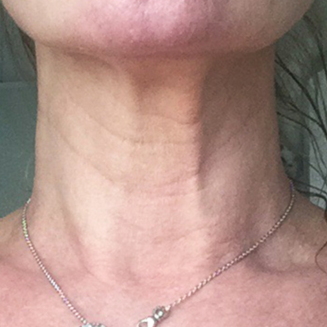 Neck Bands Anti ageing Treatment For Neck And Platysma Bands Nefertiti