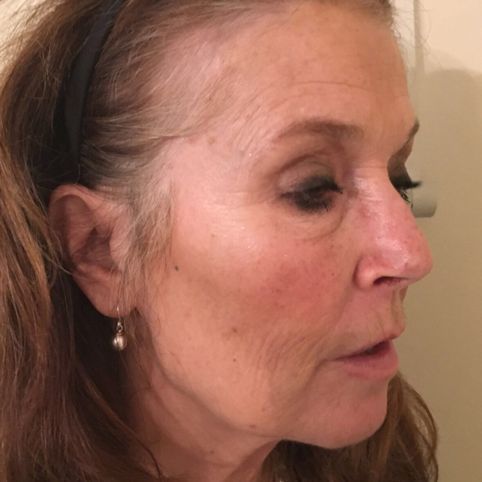 Face and neck thread lift - before