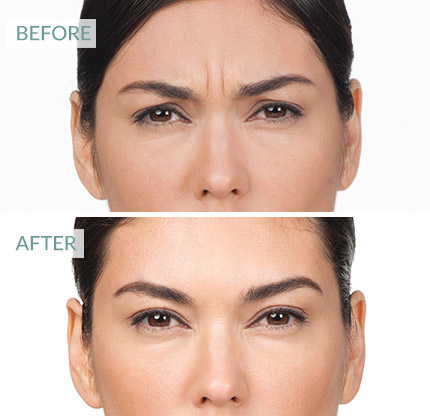 Botox Surrey, before and after