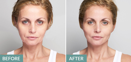 Silhouette Soft non-surgical facelift