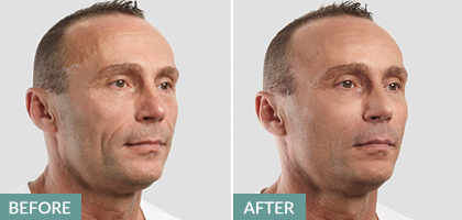 non-surgical facelift before and after - for men