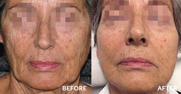 wrinkles reduced - before and after