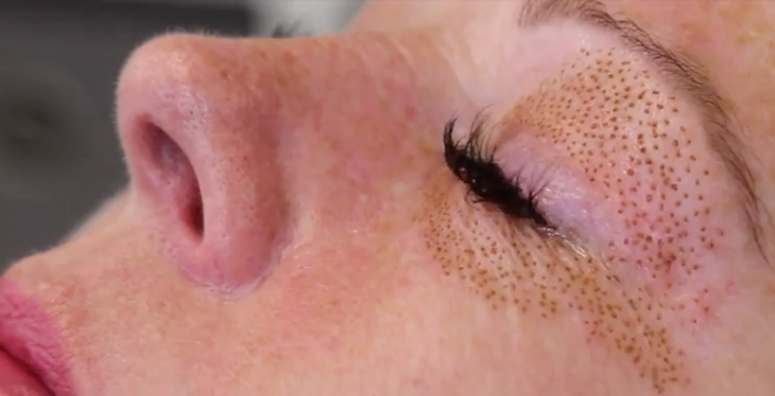 Eyelift non-surgical