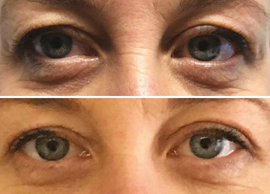 non surgical blepheroplasty drooping eyelids