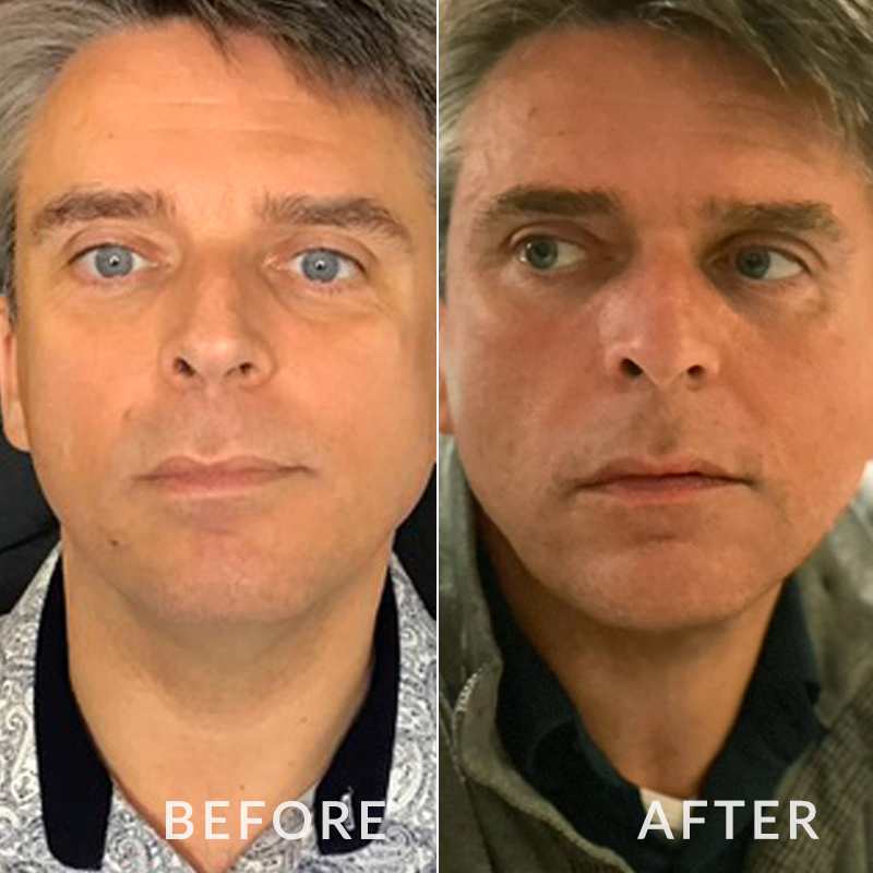 Mens double chin case study