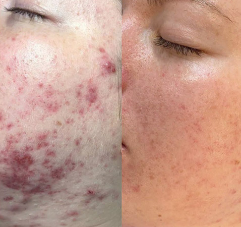 Dermalux Acne Treatment