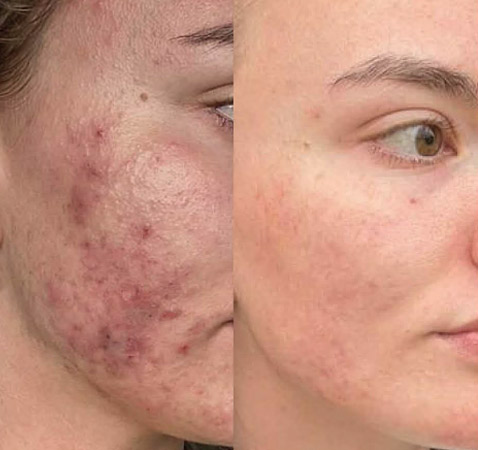 Dermalux LED Acne Treatment