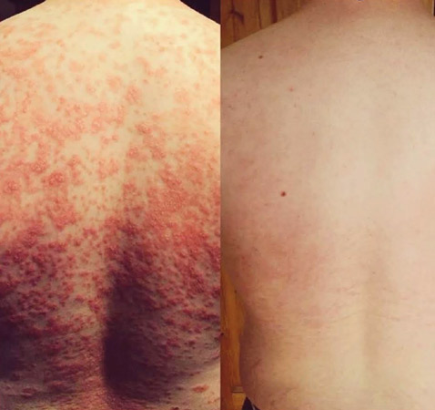 Psoriasis Treatment