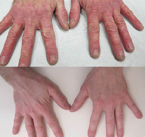 Psoriasis Treatment