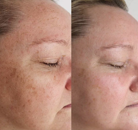 Dermalux Pigmentation Treatment				
