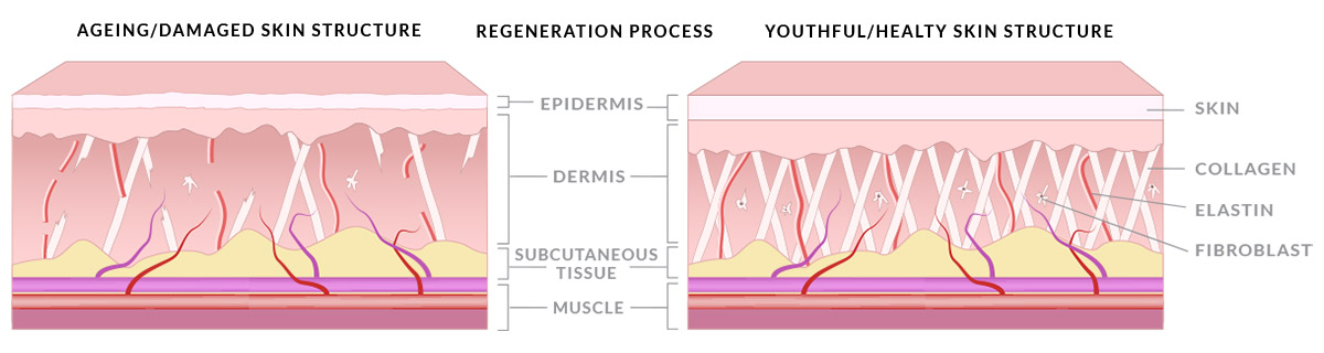 Skin regeneration