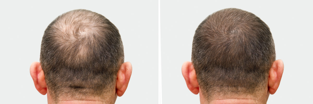 Hair loss restoration treatment surrey