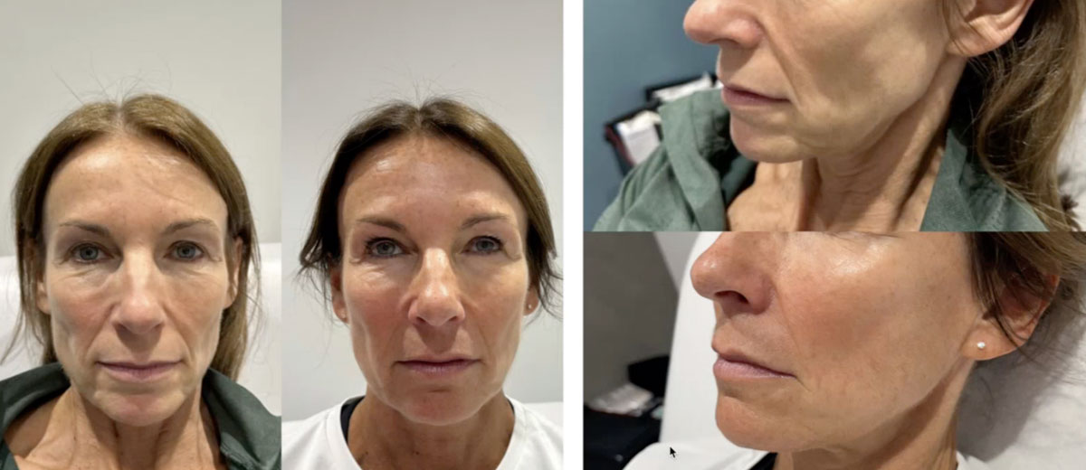 Sculptra - increase collagen