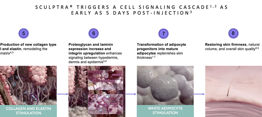 Effects of Sculptra 2025 new