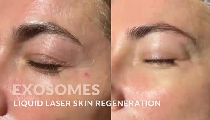 Exosomes liquid laser regeneration