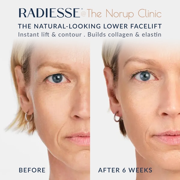 Radiesse, instant lower facelift Surrey